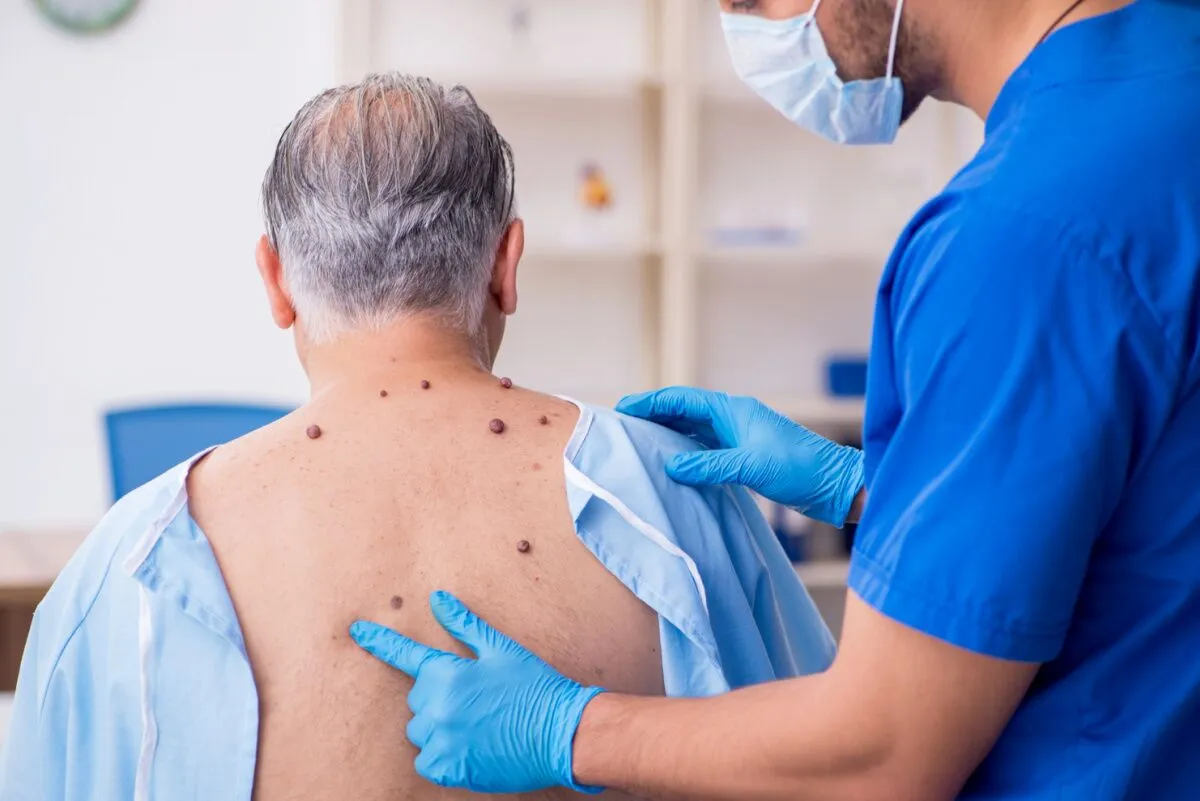 Surgical Excision of Skin Lesions